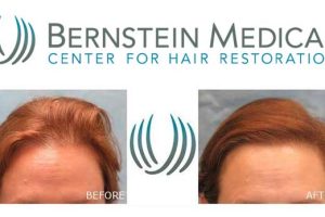 Bernstein Hair Restoration NYC