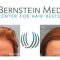 Bernstein Hair Restoration NYC